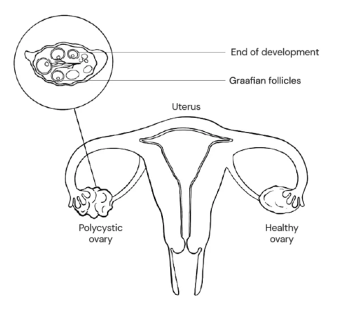 causes of PCOS