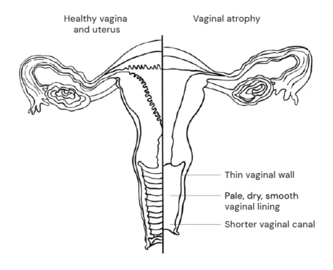 causes of menopause