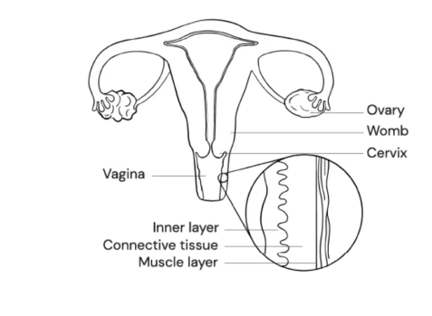 Diagram showing vaginal loosening causes and anatomy, including vagina, cervix, womb, and tissue layers.