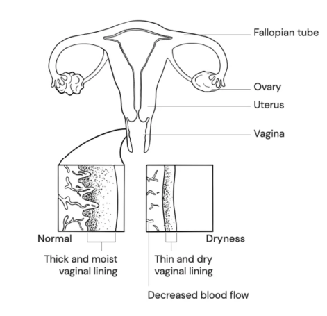 Diagram showing the female reproductive system, comparing normal thick and moist vaginal lining with dry, thin vaginal lining due to decreased blood flow.